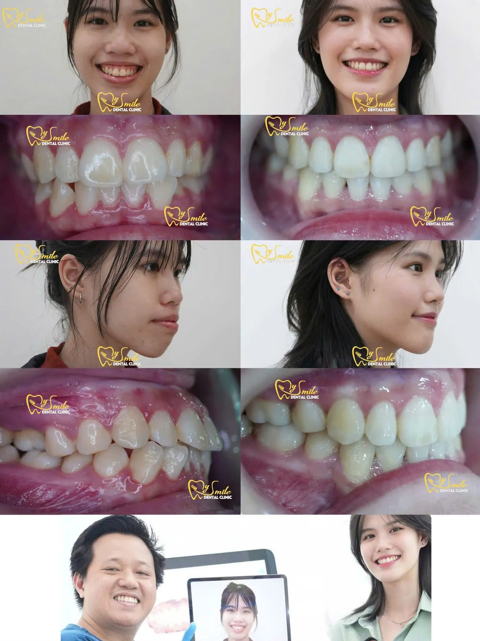 Niềng răng hô đẹp tại nha khoa