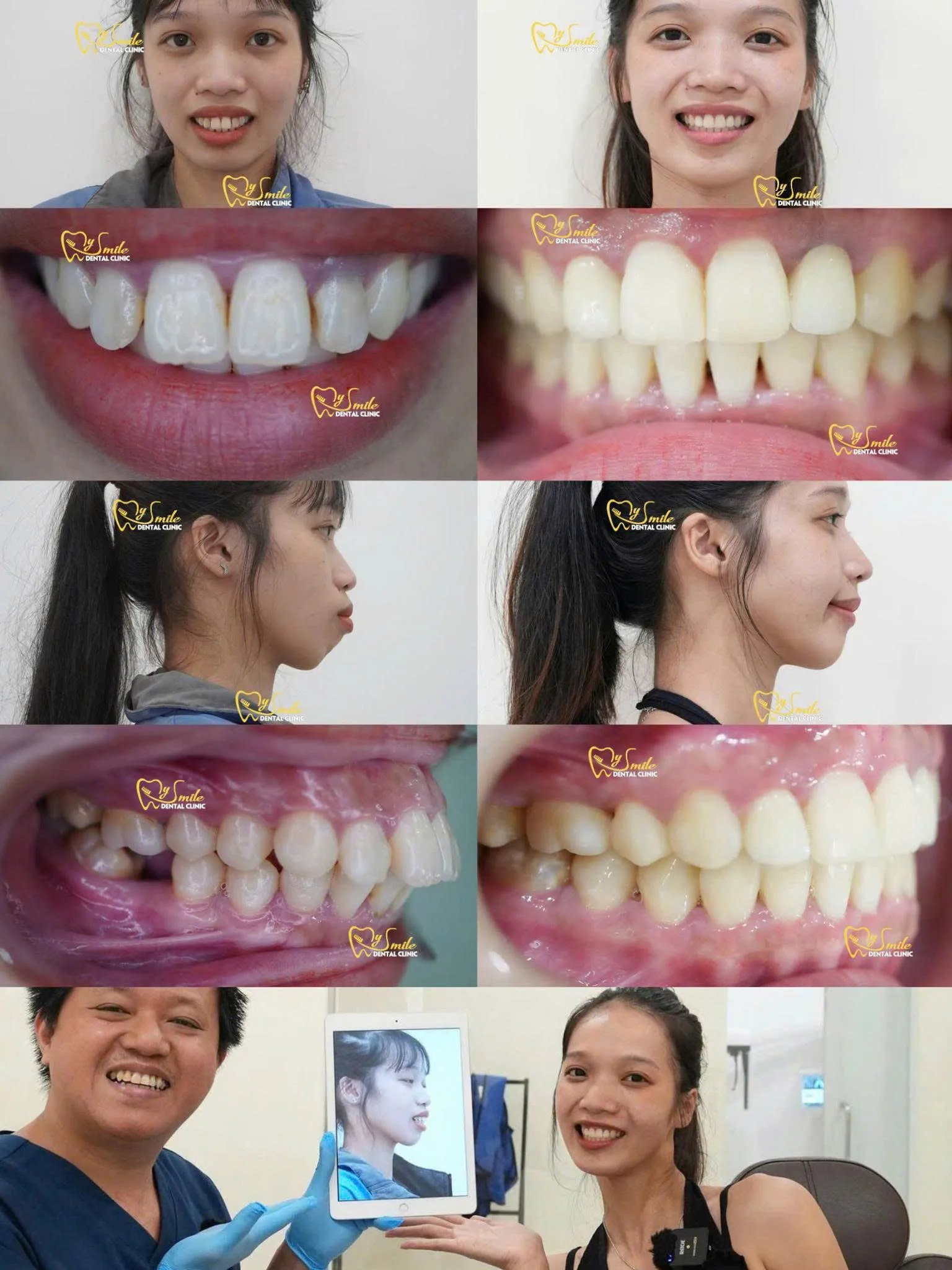 Ảnh khách niềng răng hô đẹp 3