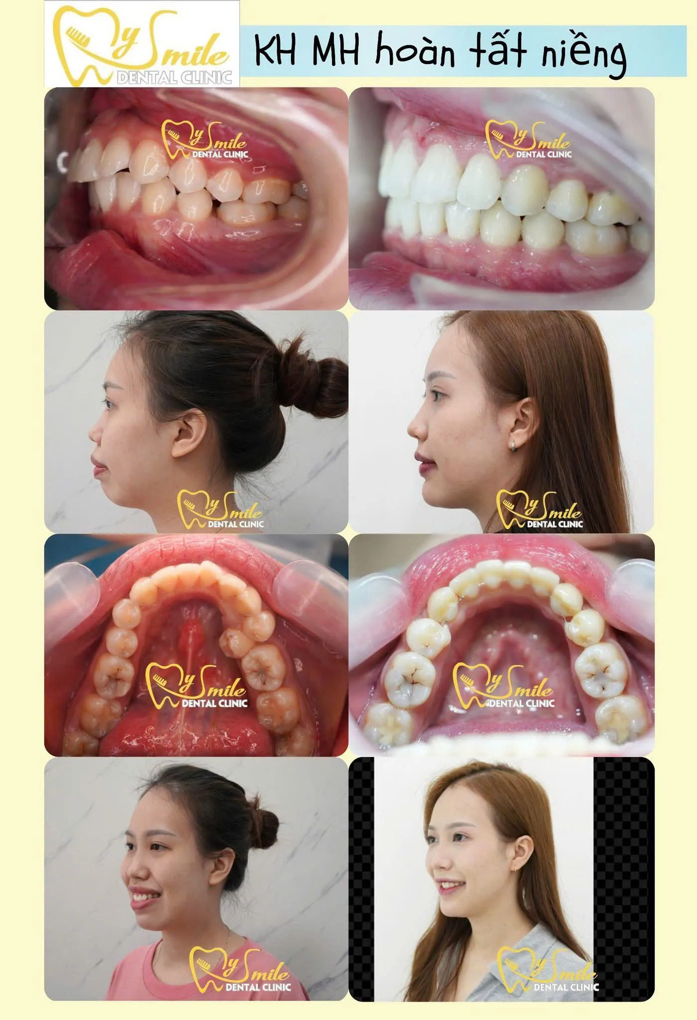 Ảnh khách niềng răng hô đẹp 4