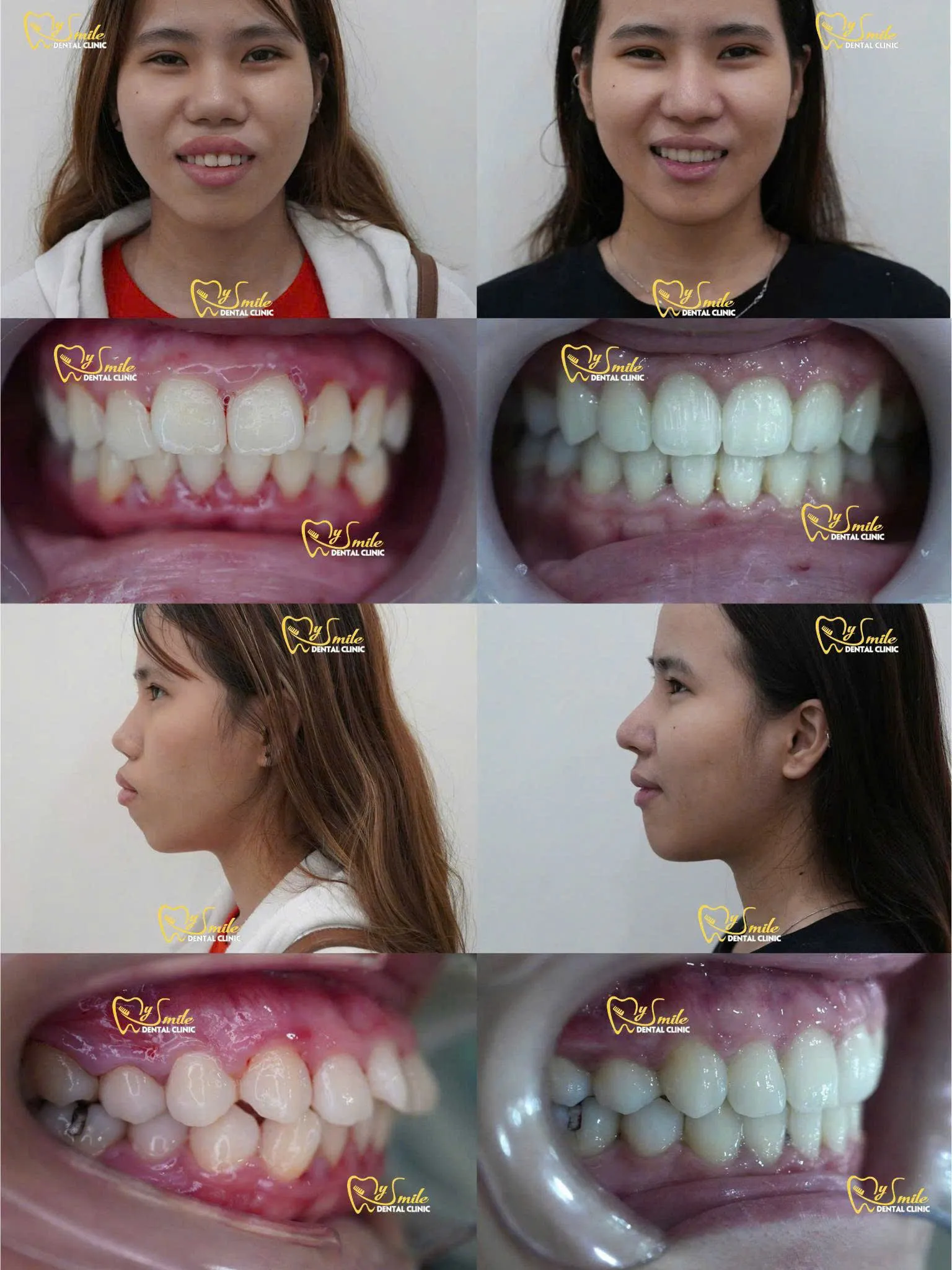 Ảnh niềng răng hô đẹp