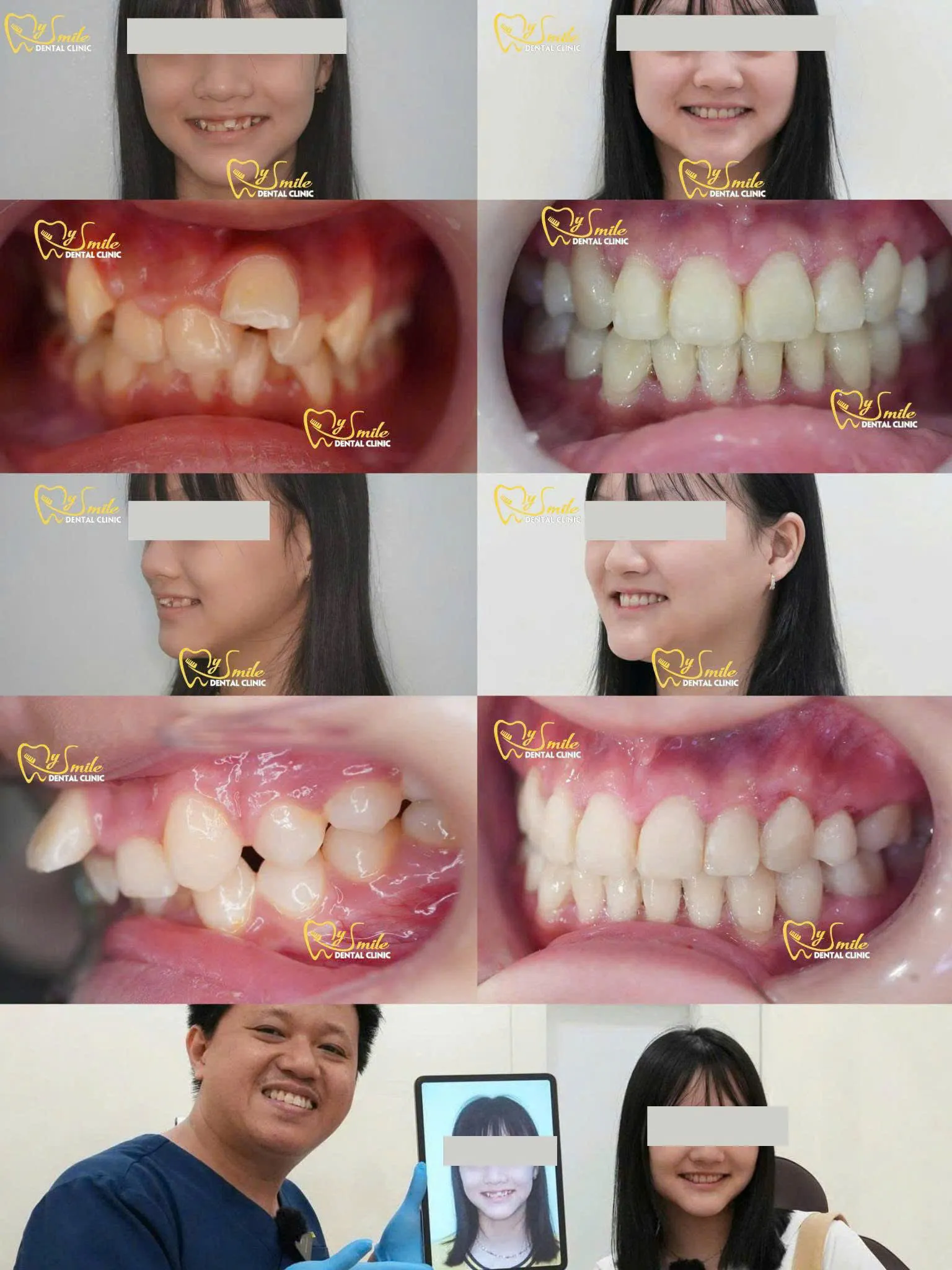 Ảnh niềng răng khấp khểnh 2