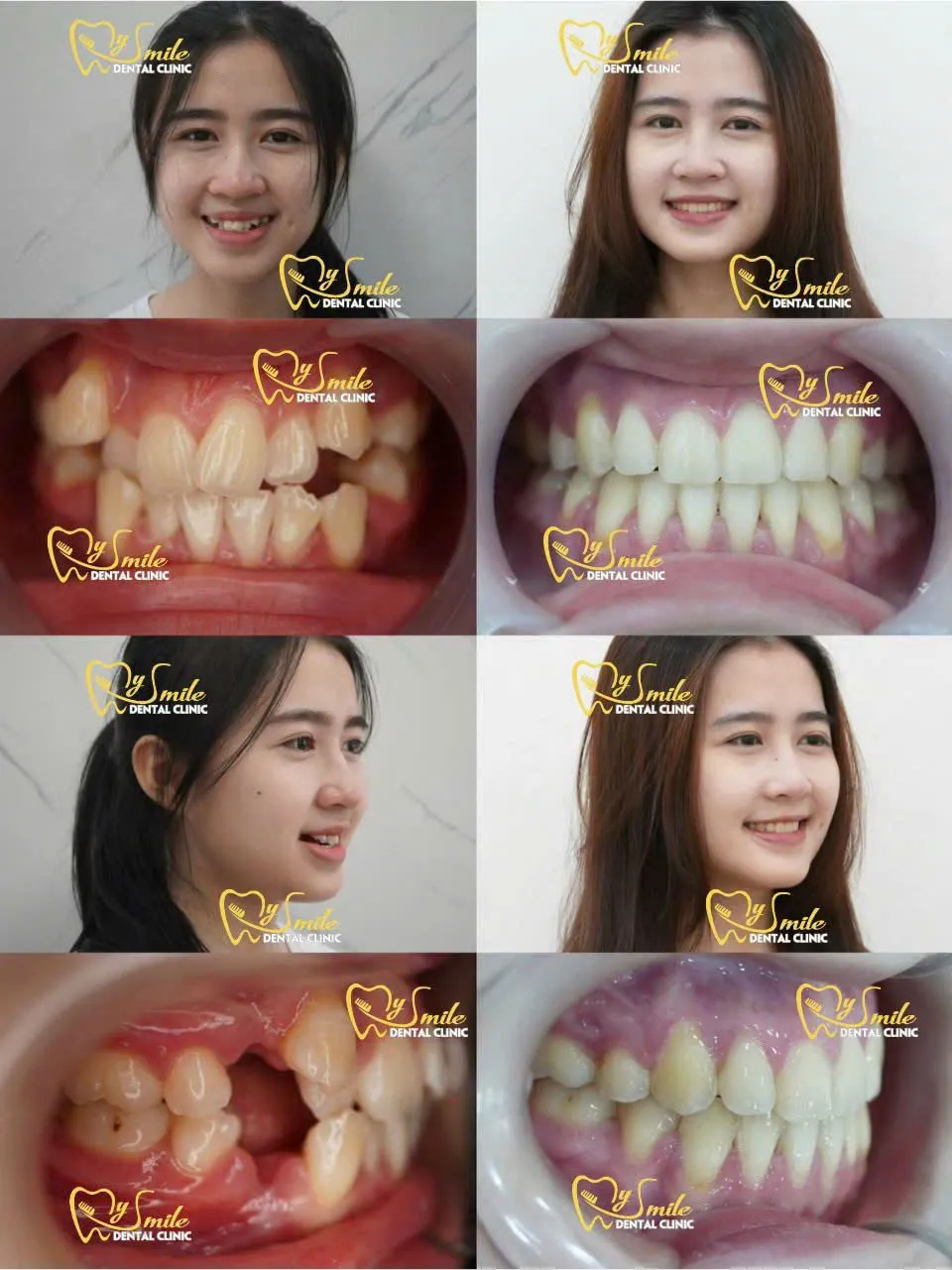 Ảnh niềng răng khấp khểnh 1