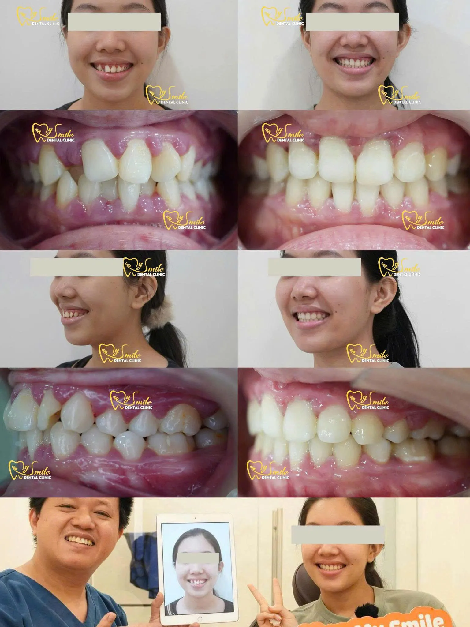 Ảnh niềng răng khấp khểnh