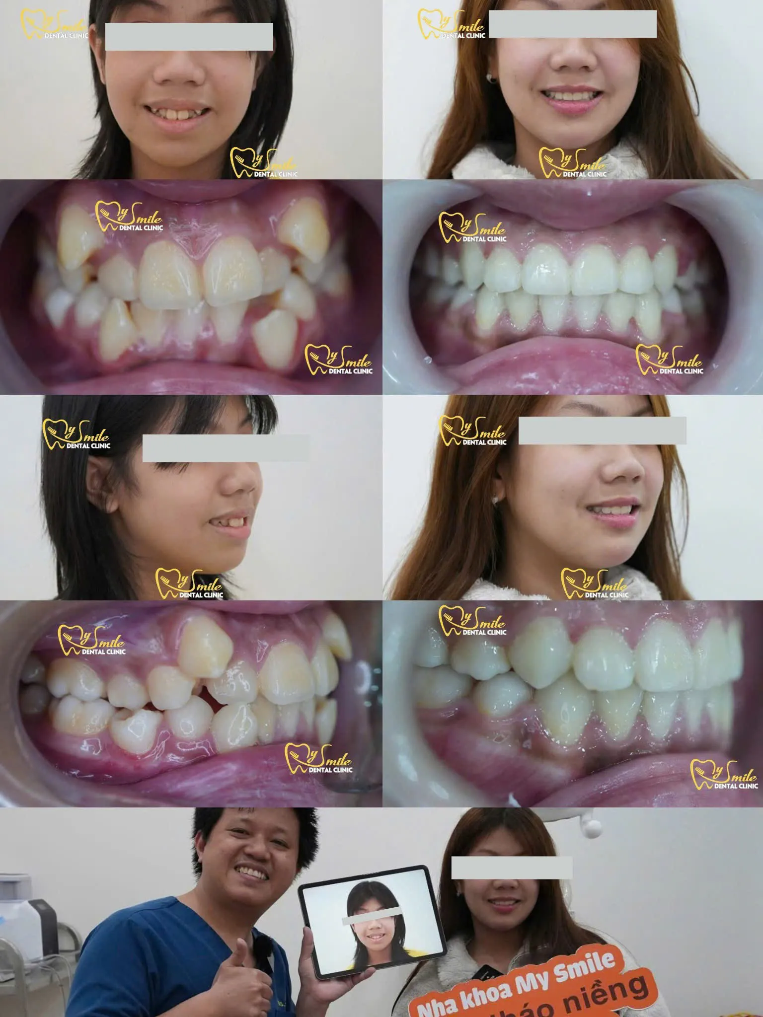 Ảnh niềng răng khấp khểnh 4