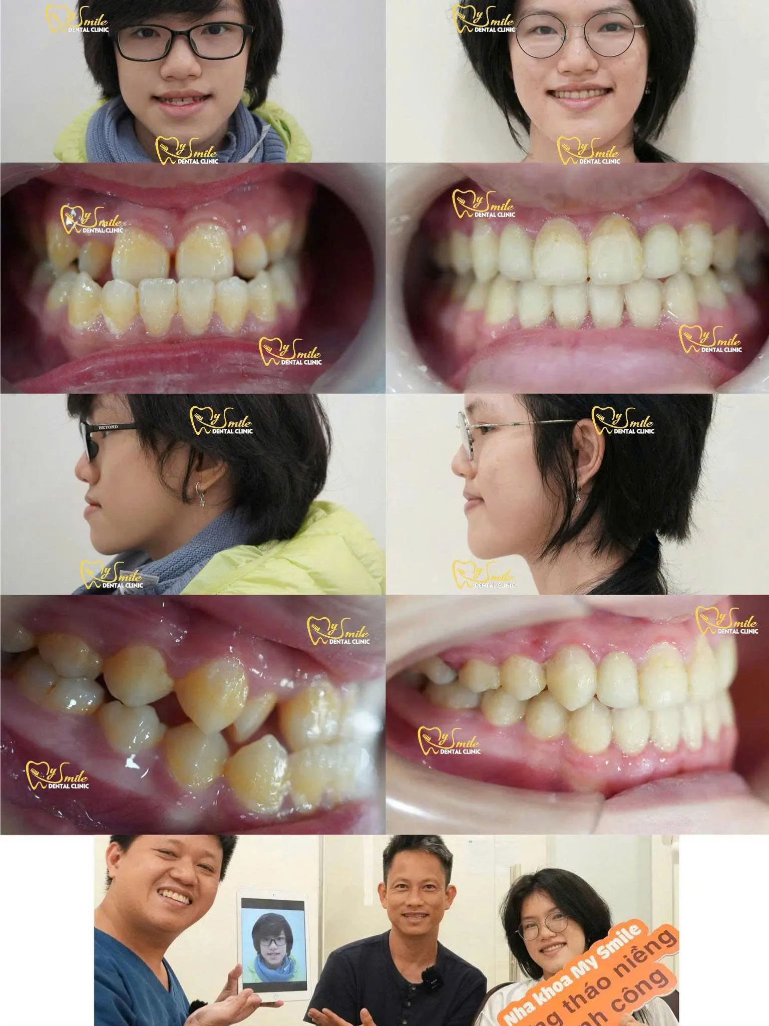 Ảnh niềng răng móm 6