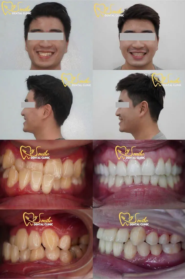 Ảnh niềng răng móm 4