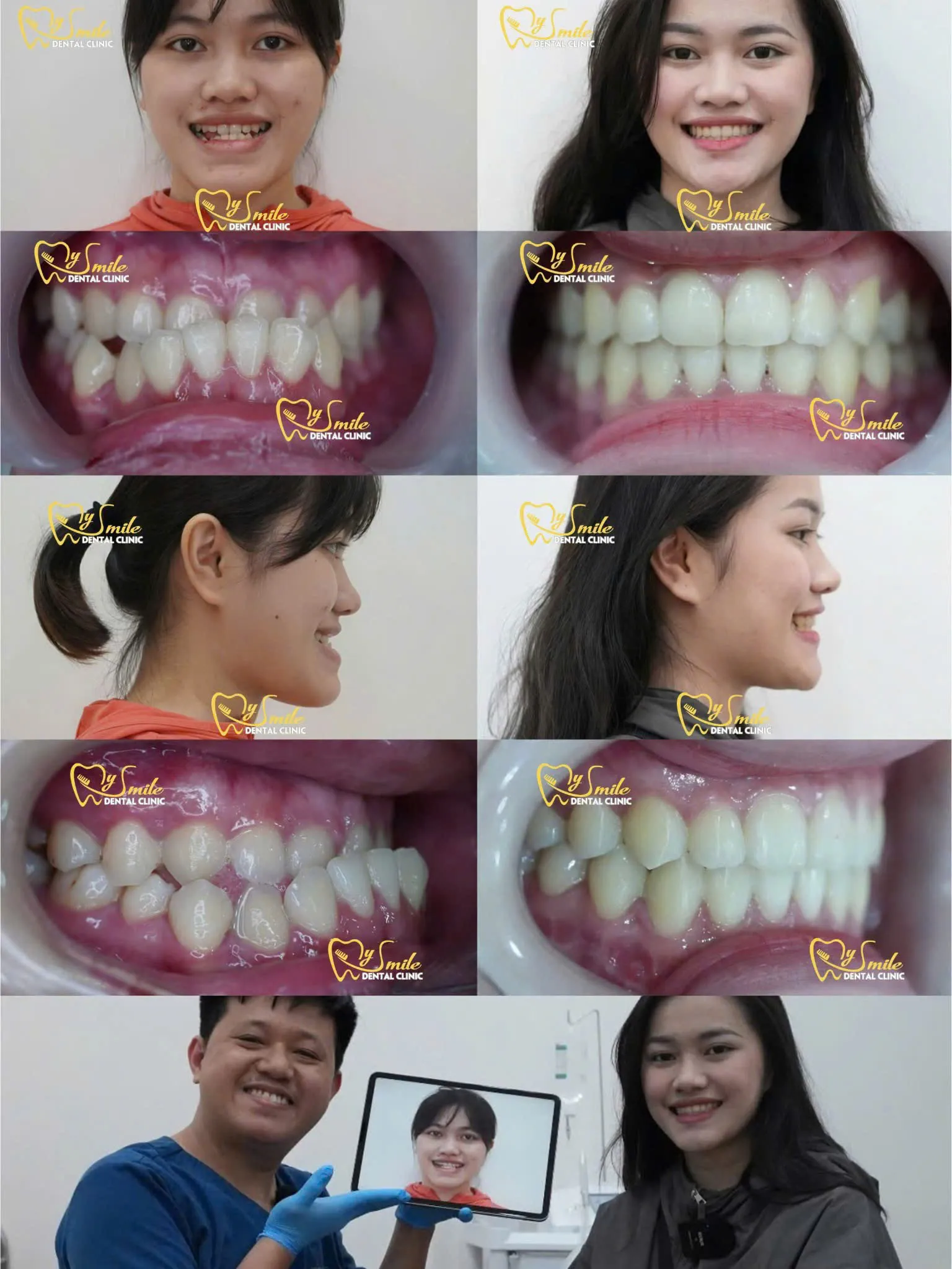 Ảnh niềng răng móm 3