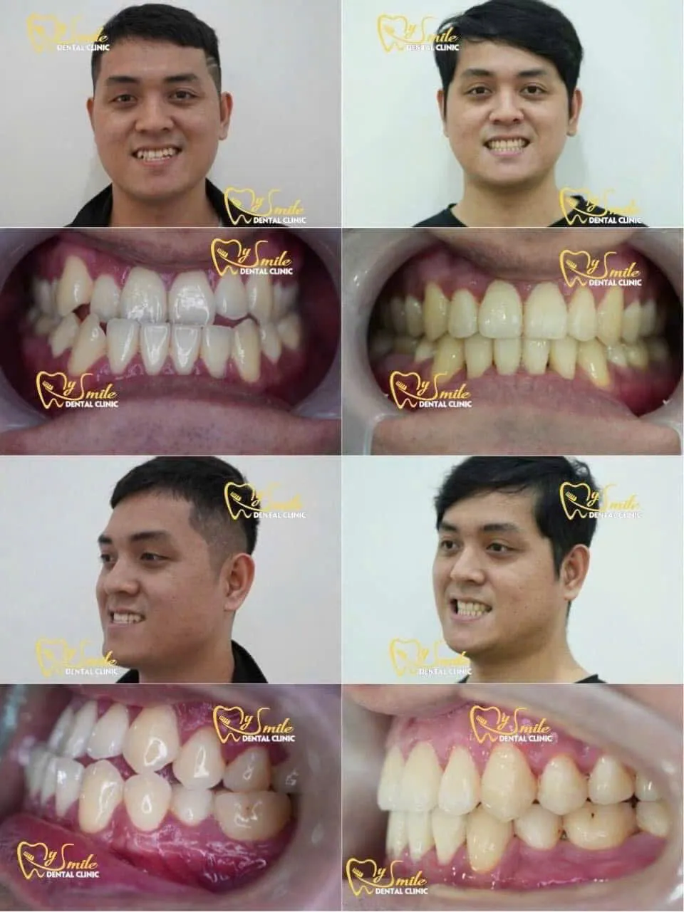 Ảnh niềng răng móm 2