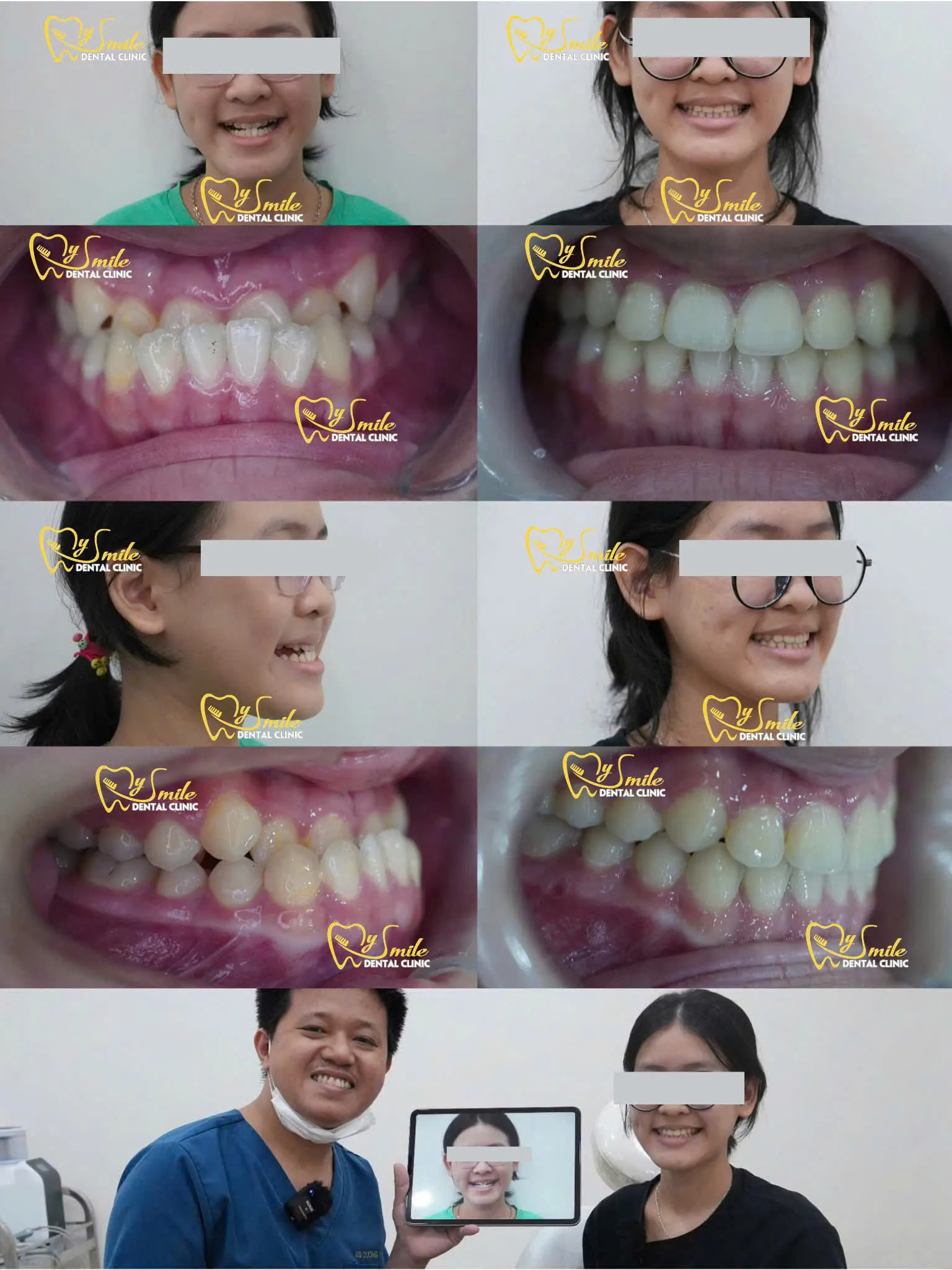 Ảnh niềng răng móm